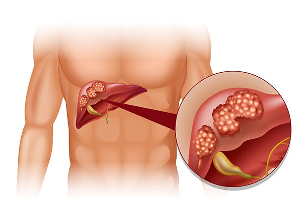 Liver Tumor Treatment In Delhi