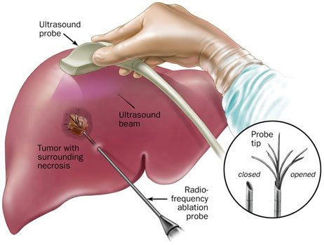 Liver Tumor Treatment In Delhi
